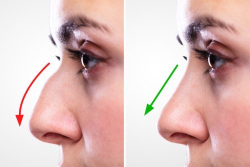 rhinoplastie Turquie